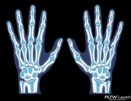 An x-ray of two hands, shown from fingertip to just below the wrist. The right wrist shows a small fracture.